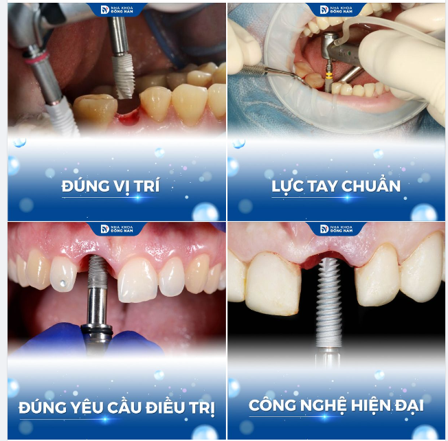 4 quy chuẩn vàng X2 tỉ lệ tích hợp của implant bền vững