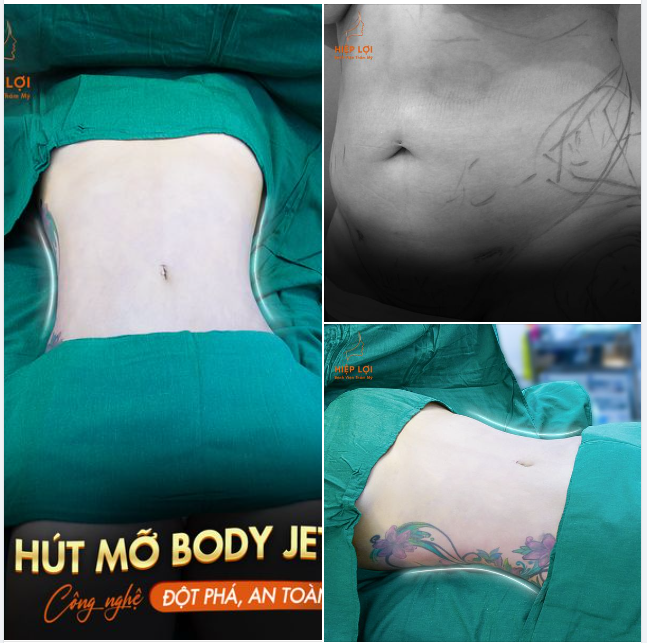 Tạm Biệt Mỡ Thừa - Siết Eo Thon Gọn Với Công Nghệ ​​​​​​​ Hút mỡ Body Jet Tại Hiệp Lợi