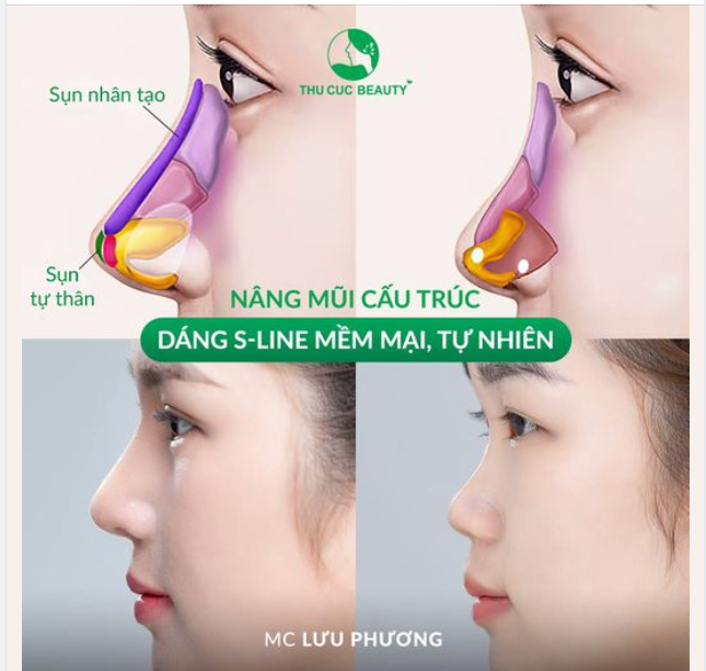 MC Lưu Phương lựa chọn dáng mũi S-line mềm mại? Còn bạn thì sao?