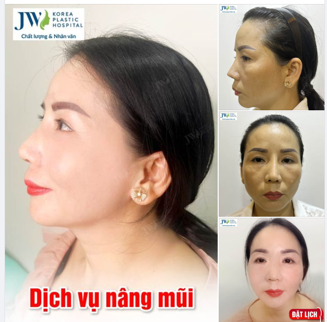 SỞ HỮU DÁNG MŨI ĐẸP TỪNG MILIMET VỚI DỊCH VỤ NÂNG MŨI TẠI JW