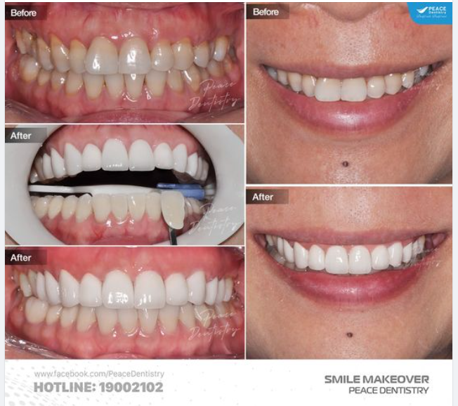 CA LÂM SÀNG 10 VENEER HÀM TRÊN ĐỦ ĐỂ NÂNG CẤP NỤ CƯỜI, TỰ TIN TOẢ SÁNG