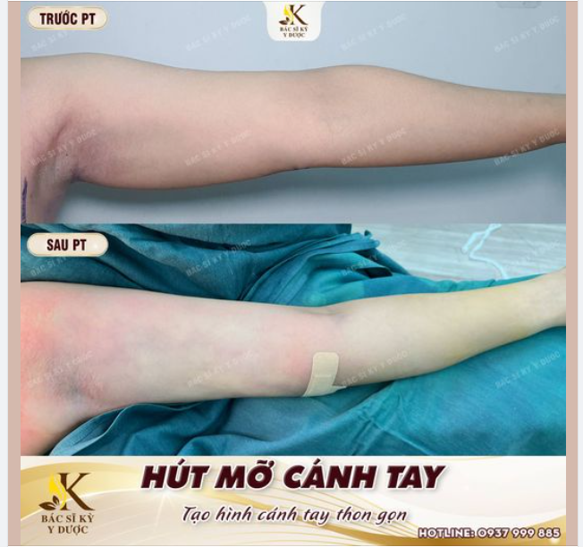 Kết Quả Hút Mỡ Cánh Tay Ngay sau Phẫu thuật