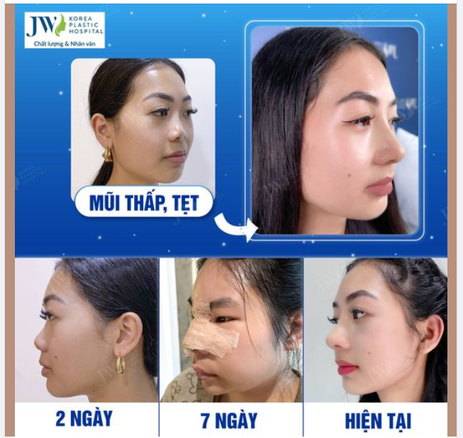 NÂNG MŨI S LINE - ĐẸP SANG CHẢNH LAI TÂY