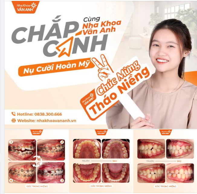 CÙNG NHA KHOA VÂN ANH CHẮP CÁNH NỤ CƯỜI HOÀN MỸ