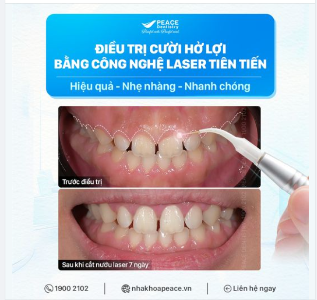 ĐIỀU TRỊ CƯỜI HỞ LỢI: HIỆU QUẢ VÀ ĐƠN GIẢN HƠN BẠN NGHĨ RẤT NHIỀU!