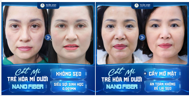 Cắt mí dưới không khó để tìm nơi thực hiện, nhưng không phải nơi nào cũng mang đến cho bạn kết quả ưng ý 