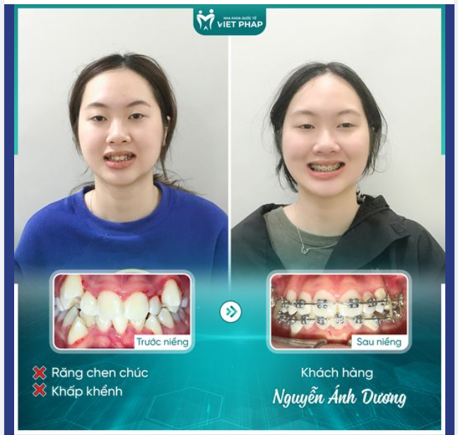 RÚT NGẮN THỜI GIAN ĐIỀU TRỊ NHỜ QUYẾT ĐỊNH NIỀNG RĂNG SỚM