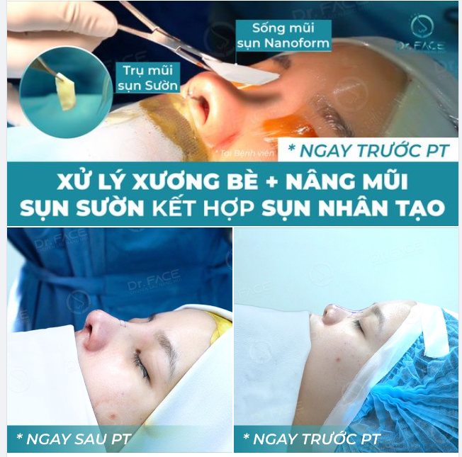 “NHẤT SỢ ĐAU NHÌ SỢ XẤU”?  Bạn có từng bị 2 nỗi sợ này “xâm chiếm” khi muốn đi nâng mũi?