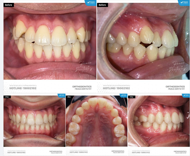 CA LÂM SÀNG NIỀNG RĂNG MẮC CÀI TỰ BUỘC CHO KHÁCH HÀNG NAM 20 TUỔI
