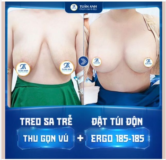 Thật hạnh phúc khi có thể giúp chị em cải thiện vòng 1 sa trễ phì đại rất khó làm như thế này!