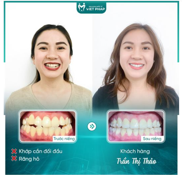 HỒI SINH NỤ CƯỜI MANG NHIỀU KHUYẾT ĐIỂM NHỜ NIỀNG RĂNG