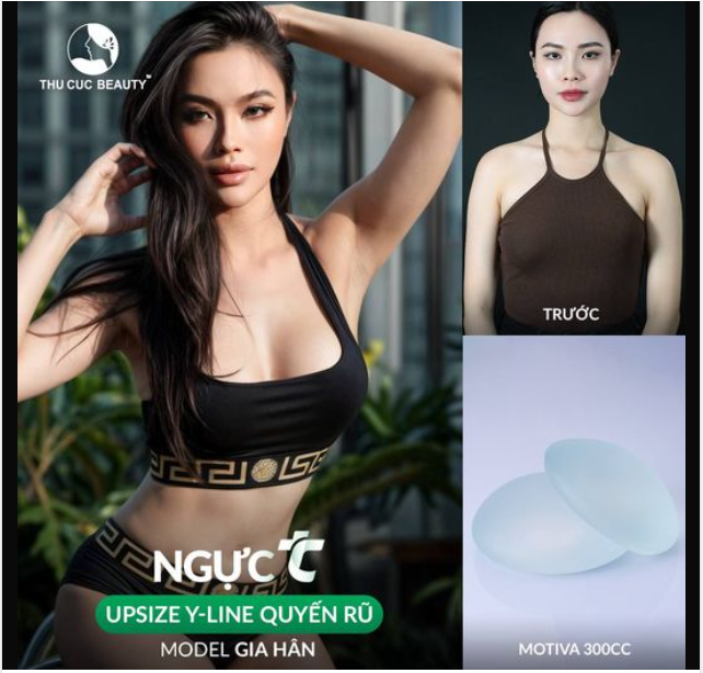 Ưu đãi chào hè Ngực TC - Nâng ngực đẹp "mê ly"