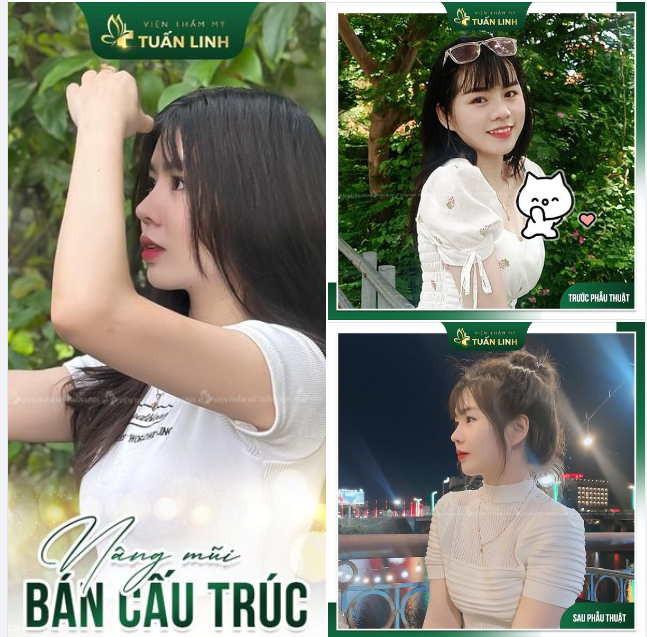 Nâng mũi bán cấu trúc Cho dáng tự nhiên, thanh tú cực mê