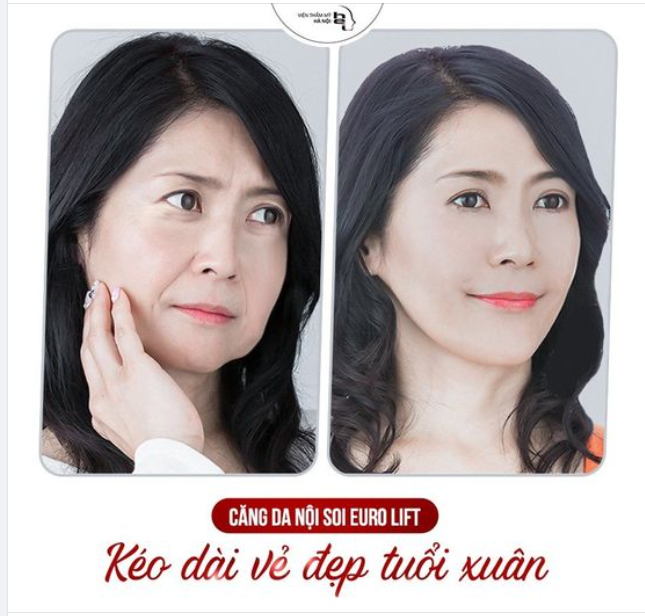 CĂNG DA NỘI SOI EURO LIFT - TÁI SINH LÀN DA TƯƠI TRẺ