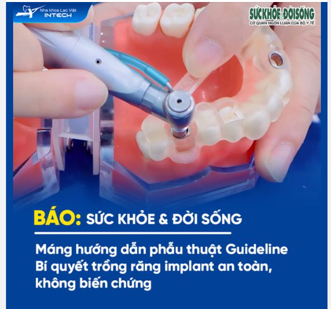 MÁNG GUIDELINE: BÍ QUYẾT TRỒNG RĂNG IMPLANT AN TOÀN, KHÔNG BIẾN CHỨNG