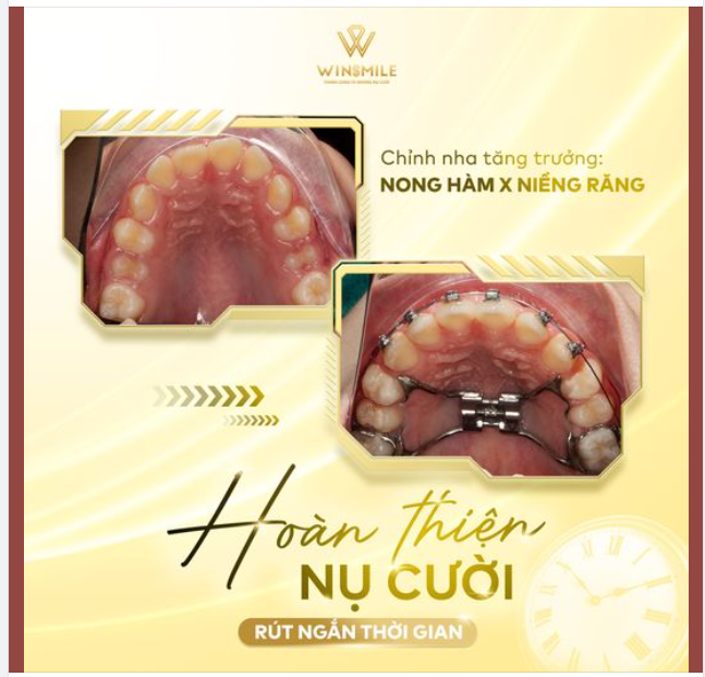 CHỈNH NHA TĂNG TRƯỞNG - TƯỞNG DỄ MÀ KHÓ, TƯỞNG KHÓ MÀ DỄ