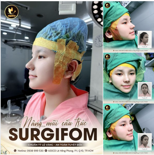 NÂNG MŨI CẤU TRÚC SURGIFORM CHUẨN TỶ LỆ VÀNG - AN TOÀN KHÔNG BIẾN CHỨNG