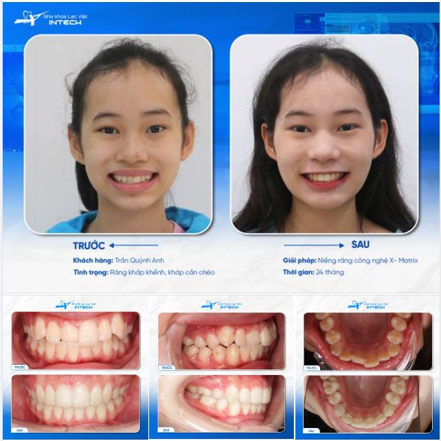 NIỀNG RĂNG Ở ĐỘ TUỔI VÀNG ĐỂ LỚN LÊN TRỞ THÀNH MỘT THIẾU NỮ XINH ĐẸP!