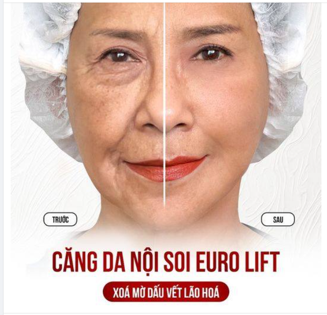 CĂNG DA NỘI SOI EURO LIFT có thể LÀM MỜ DẤU VẾT CỦA THỜI GIAN