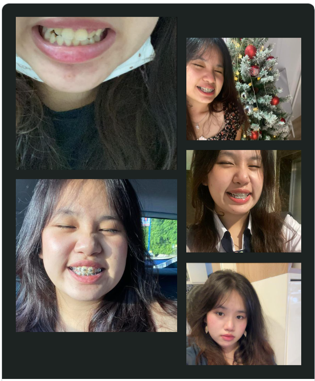 NIỀNG RĂNG HÔNG ĐÁNG SỢ LẮM ĐÂUU!