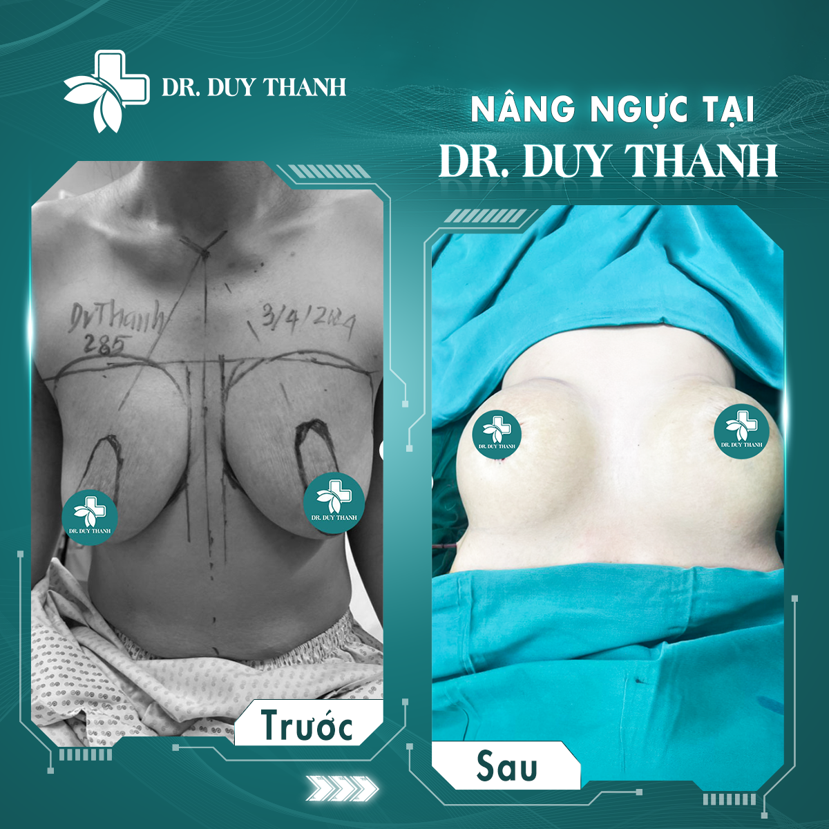 Treo sa trễ cùng Dr Duy Thanh