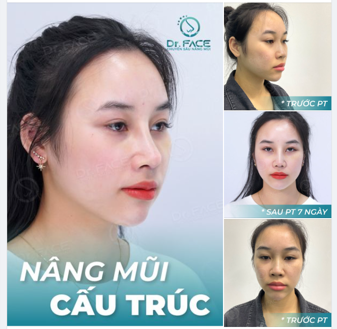 Ai cũng nói bạn ấy DẬY THÌ THÀNH CÔNG sau nâng mũi cấu trúc