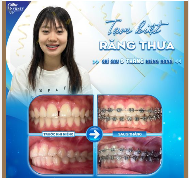 TẠM BIỆT RĂNG THƯA - CHỈ SAU 9 THÁNG NIỀNG RĂNG