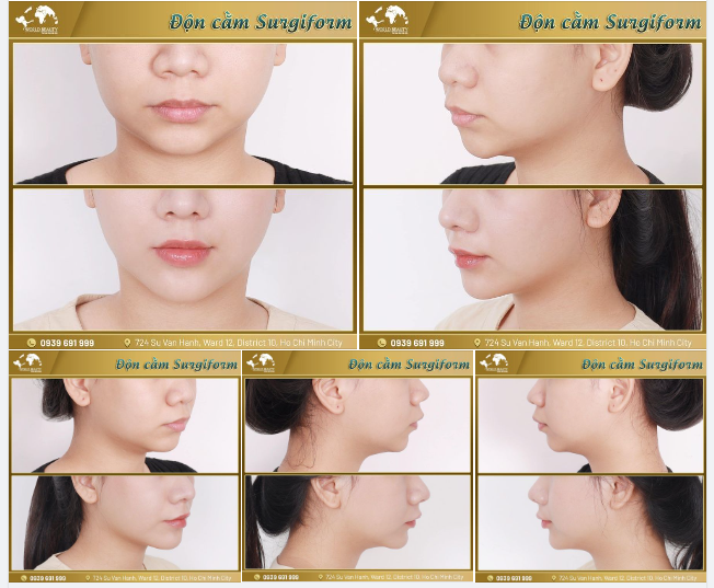 Sở hữu ngay gương mặt đạt chuẩn tỷ lệ vàng chỉ với phẫu thuật Độn cằm Surgiform.