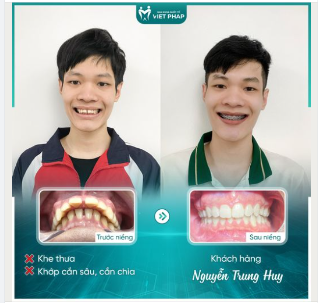 KẾT QUẢ 19 THÁNG DÀN ĐỀU RĂNG CHÌA, KHE THƯA CÙNG MẮC CÀI KIM LOẠI