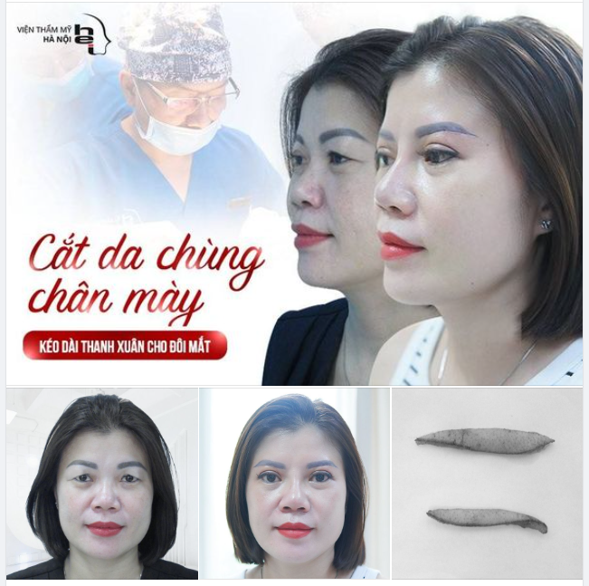 CẮT CHÙNG DA CHÂN MÀY - KÉO DÀI THANH XUÂN CHO ĐÔI MẮT