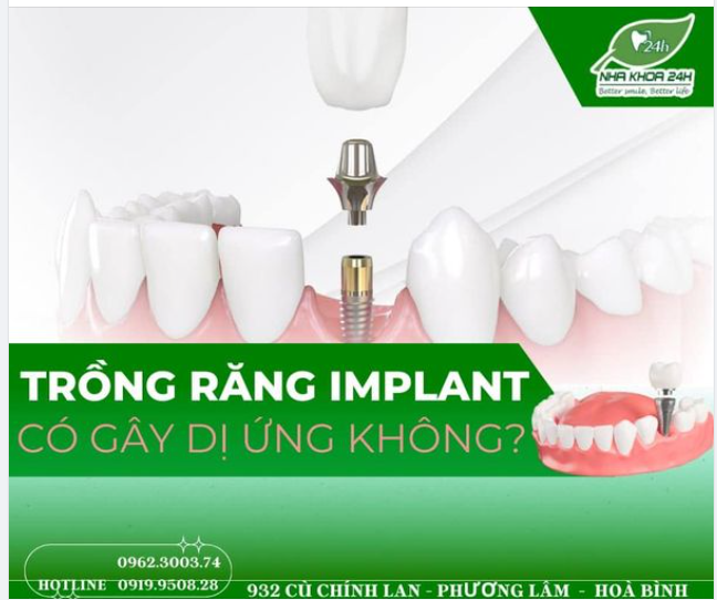 Trồng răng implant CỰC KỲ HIẾM gây hiện tượng dị ứng cho cơ thể. Vì những lý do sau: