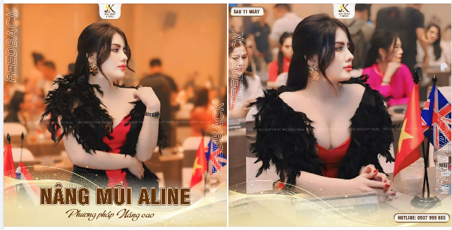 SỞ HỮU NÉT ĐẸP “CHANH XẢ” SAU NÂNG MŨI ALINE
