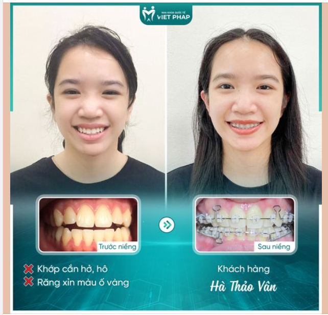 NIỀNG RĂNG - CHÌA KHÓA CỦA HÀM RĂNG ĐỀU ĐẸP VÀ KHỎE MẠNH