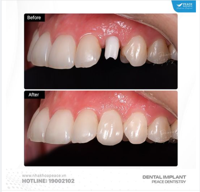 IMPLANT RĂNG CỬA  tối ưu thẩm mỹ sau cùng bằng lựa chọn Zirconia Customized Abutment