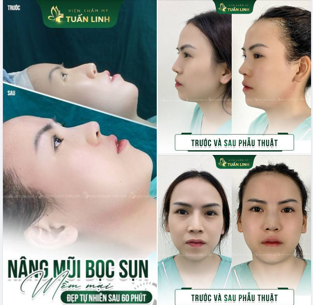 Nâng mũi bọc sụn - Dáng mũi mềm mại, đẹp tự nhiên sau 60 phút!