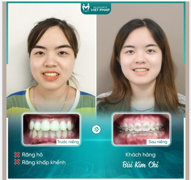 XINH HƠN, TỰ TIN HƠN SAU GẦN 2 NĂM NIỀNG RĂNG