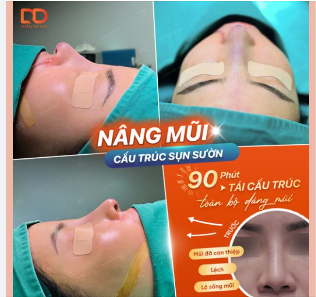 ẤN TƯỢNG DÁNG MŨI SỤN SƯỜN SAU PHẪU THUẬT