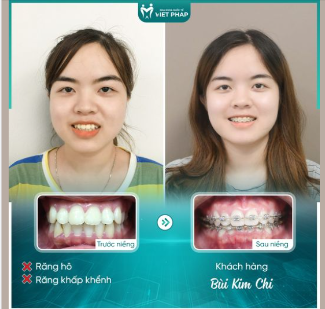 XINH HƠN, TỰ TIN HƠN SAU GẦN 2 NĂM NIỀNG RĂNG