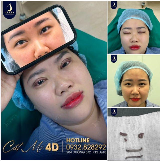 45 phút cắt mí 4D, 7 ngày mí đẹp tự nhiên