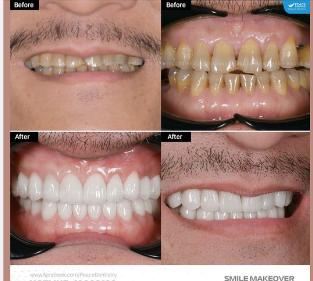 VENEER SỨ TRÊN RĂNG NHIỄM TE-TRACYCLINE | LÀM MỘT LẦN CHO KẾT QUẢ DÀI LÂU