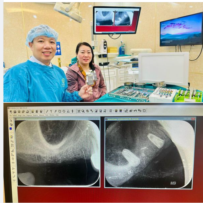 MẤT RĂNG - TRỒNG IMPLANT KHẮC PHỤC ĂN NHAI