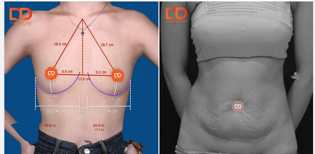 Cập nhật hình ảnh trước phẫu thuật của 2 ca phẫu thuật đại phẫu Nâng V1 và Tạo hình thành bụng ngày hôm nay.