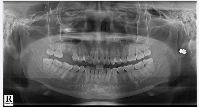 ĐẦU TƯ TRỒNG RĂNG IMPLANT, KHOẢN "SINH LỜI" HIỆU QUẢ CHO NGƯỜI MẤT RĂNG