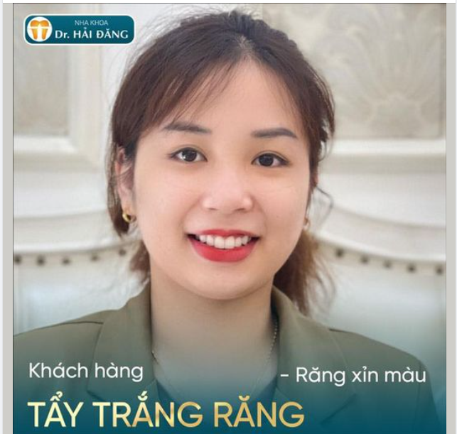 Công nghệ Laser Whitening TẨY TRẮNG RĂNG