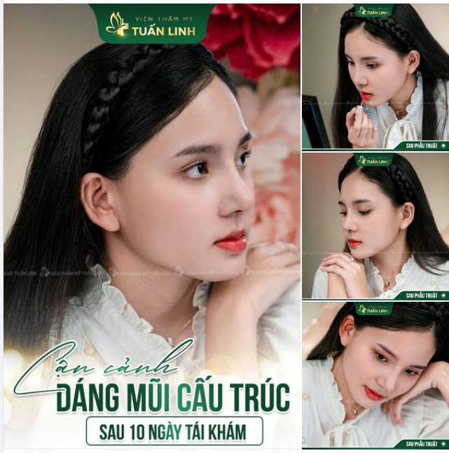 Chiếc mũi cấu trúc tái khám và cắt chỉ sau 10 ngày thực hiện nha cả nhà.