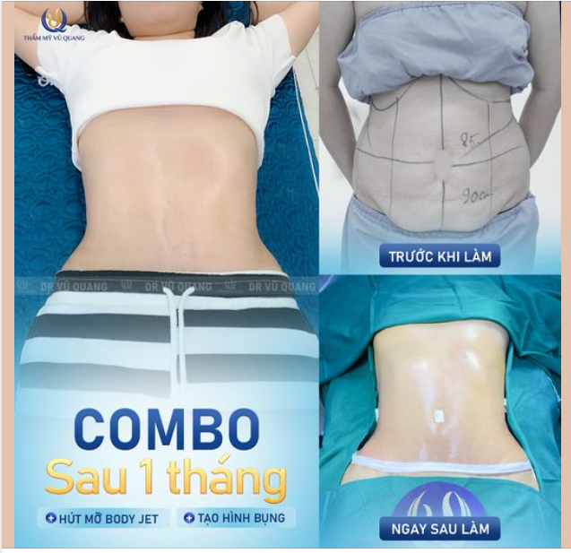 Sở hữu vòng eo “thắt đáy lưng ong” sau hút mỡ Body Jet kết hợp tạo hình thành bụng