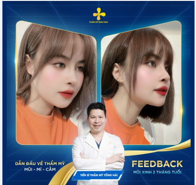 Lên thêm 1 chiếc feedback nâng mũi Golden Line của bạn Thảo đến từ Thái Nguyên