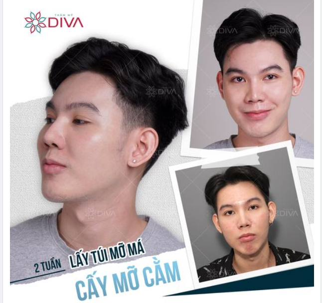 LẤY TÚI MỠ MÁ, TIÊM MỠ CẰM: KẾT QUẢ SAU 10 NGÀY THẨM MỸ