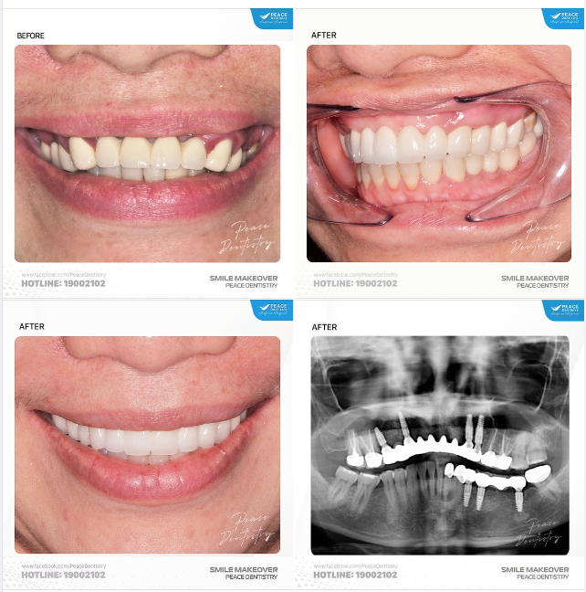IMPLANT THAY THẾ HOÀN HẢO CHO CẦU RĂNG SỨ DÀI, XUỐNG CẤP