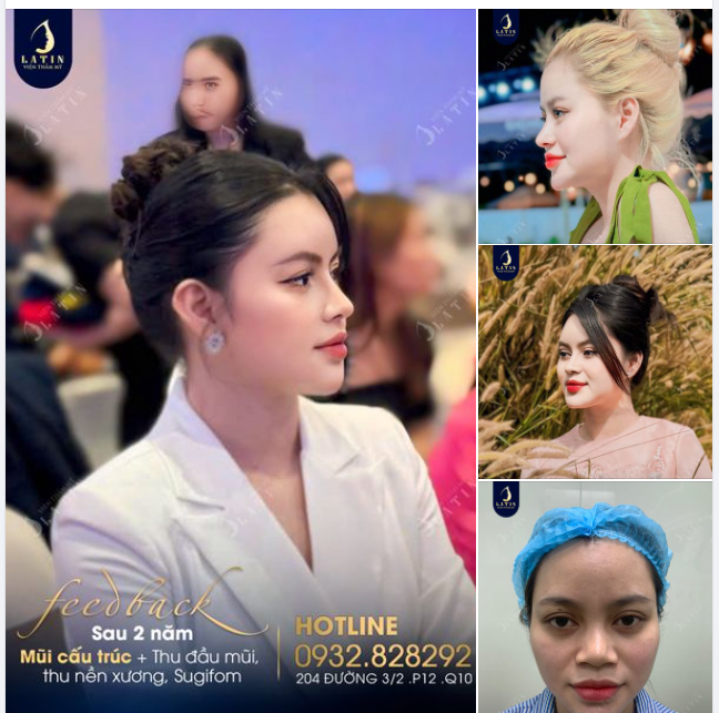 Em gái gửi feedback mũi cấu trúc surgiform sau 2 năm